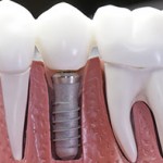 dental implant close up